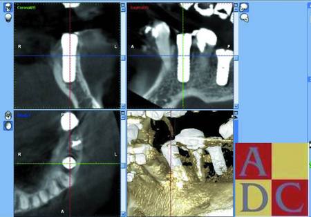 34 with implant.pdf.jpg